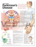 Understanding Parkinson’s Disease Anatomical Chart, 2nd Edition